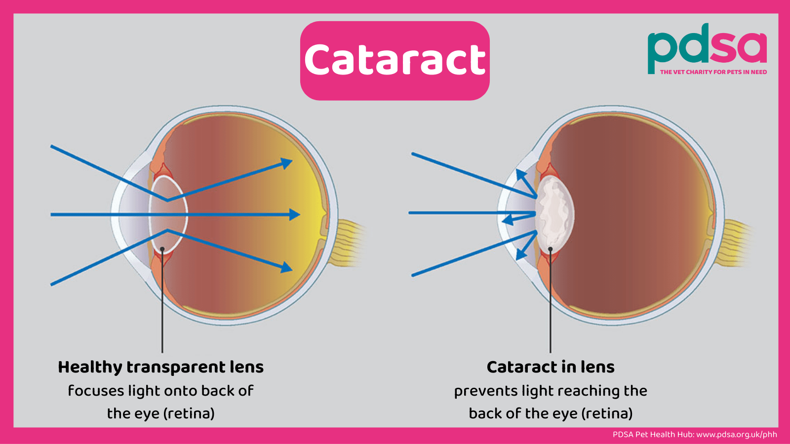 Two diagrams of an eye from the side. The diagram on the left shows light passing through a healthy transparent lens., hitting the back of the eye The diagram on the right shows light bouncing off a lens with a cataract inside it, never reaching the back of the eye.