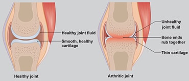 Illustration showing healthy joint vs one with arthritis