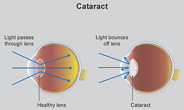 can you slow down cataracts in dogs